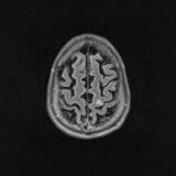 "Em 15 minutos eu mexi a mão": a recuperação de Danilo após um AVC e o tratamento que chegou no tempo certo